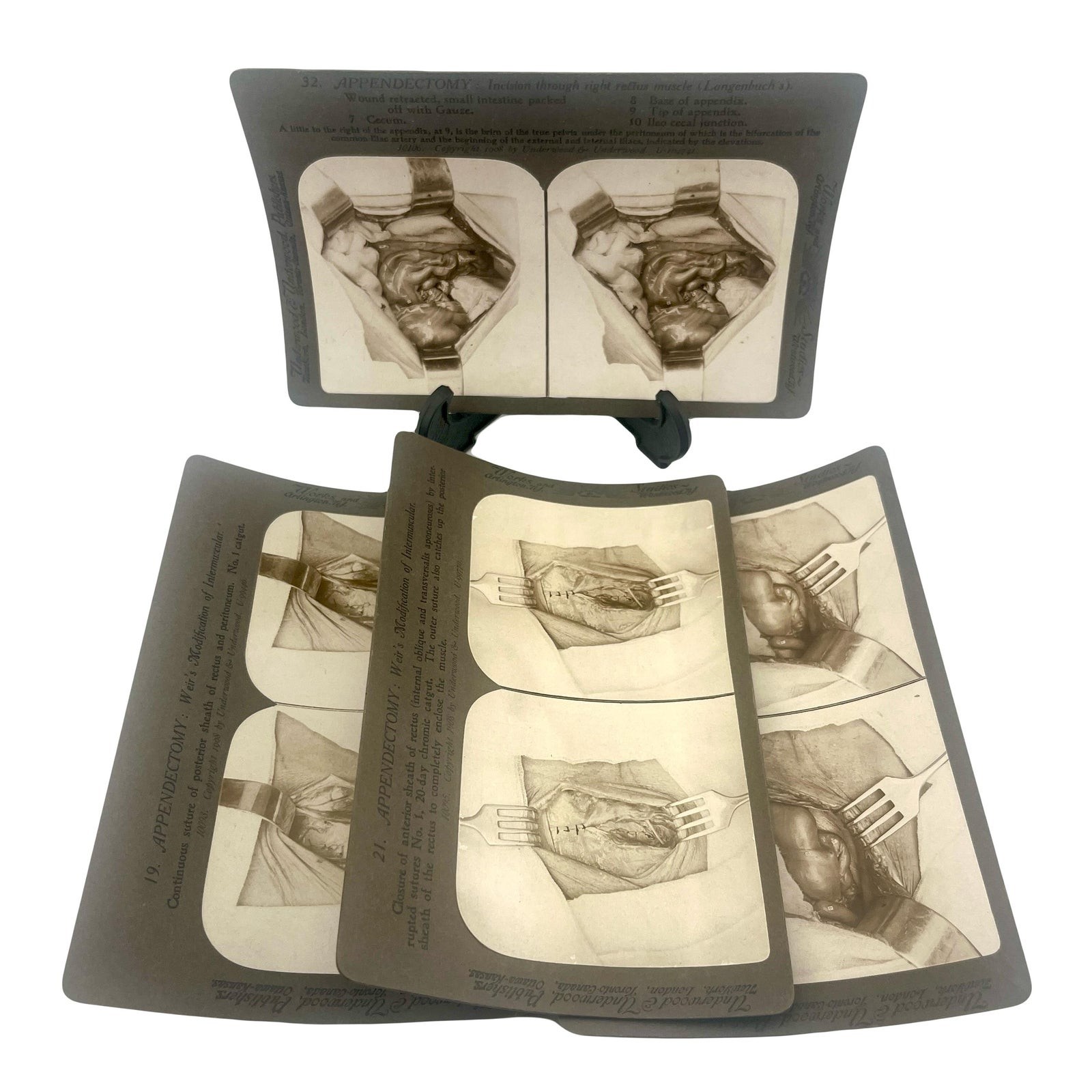 Antique 1908 Surgical Stereoview Cards | Appendectomy | Underwood & Underwood