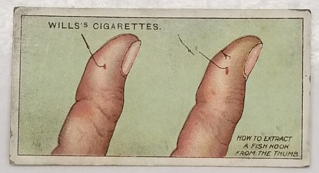 Wills's First Aid TO EXTRACT FISH-HOOK Medical Vintage Cigarette Card #49
