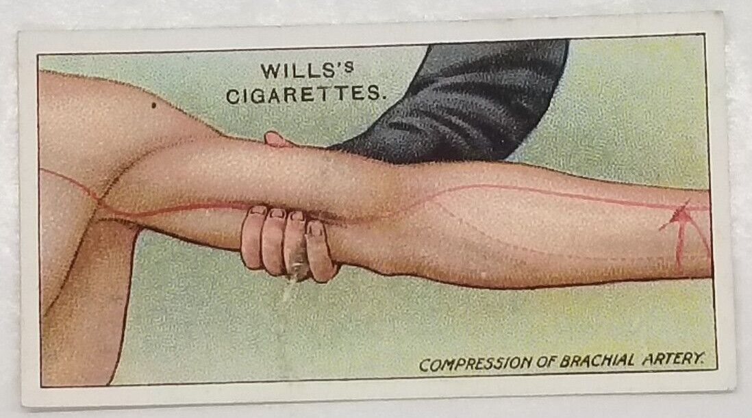 Wills\'s First Aid COMPRESSION OF ARTERY Medical Vintage Cigarette Card #12