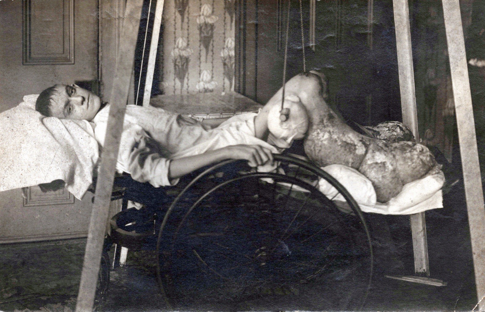 1916 Medical RPPC Elephantiasis Patient Memorial Hospital Corry PA Amputation