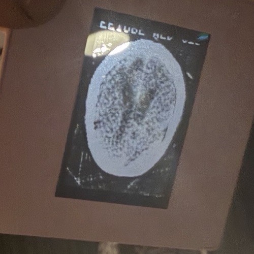 Vtg Medical 35mm Slide Lot w/ Box - 140 Human Brain CT Scans Oddities Archive