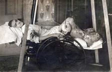 1916 Medical RPPC Elephantiasis Patient Memorial Hospital Corry PA Amputation picture